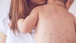 ‘Measles parties’ to give their kids the virus so they become immune