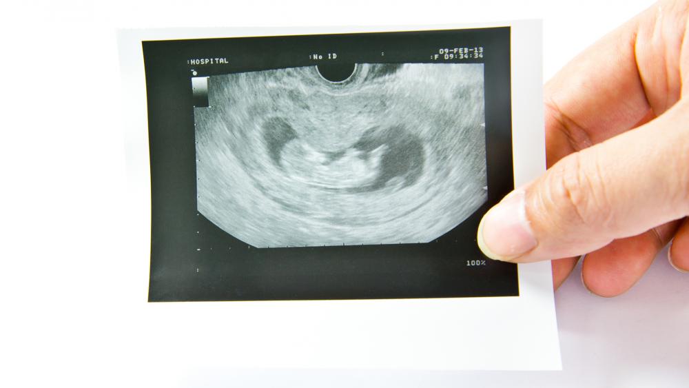 Missouri Passes 8-Week Abortion Ban, Planned Parenthood Retaliates by Slurring ‘White Men’