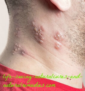 At Last! A Natural Cure for Shingles Has Been Found…
