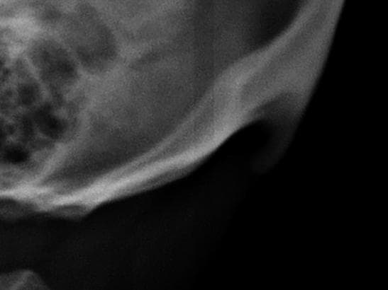 Younger generations are growing horns in the back of their head